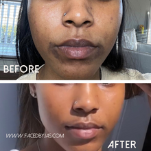 Load image into Gallery viewer, Dark Marks/ Hyperpigmentation Bundle